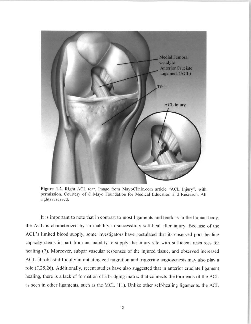 Figure 1.2. Right ACL tear. Image from MayoClinic.com article "ACL Injury", with permission. Courtesy of 0 Mayo Foundation for Medical Education and Research. All rights reserved.