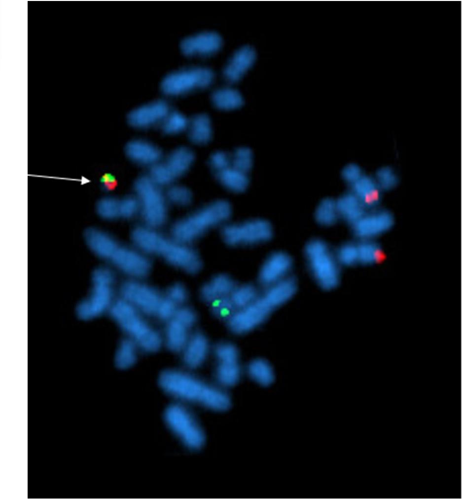 FISH A metaphase cell positive for the bcr/abl rearrangement (associated with chronic myelogenous leukemia) using FISH. The chromosomes can be seen in blue.