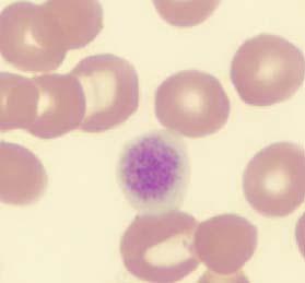 Coagulation Testing Normal CBC except for thrombocytopenia (80,000 X10 9 /L) Giant Platelets on peripheral blood smear Normal PT, APTT, TT, VWF, FVIII, FIX, and FXIII