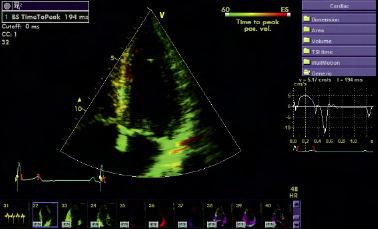 TSI Advanced Tissue Synchronization Imaging (TSI) quantifies LV
