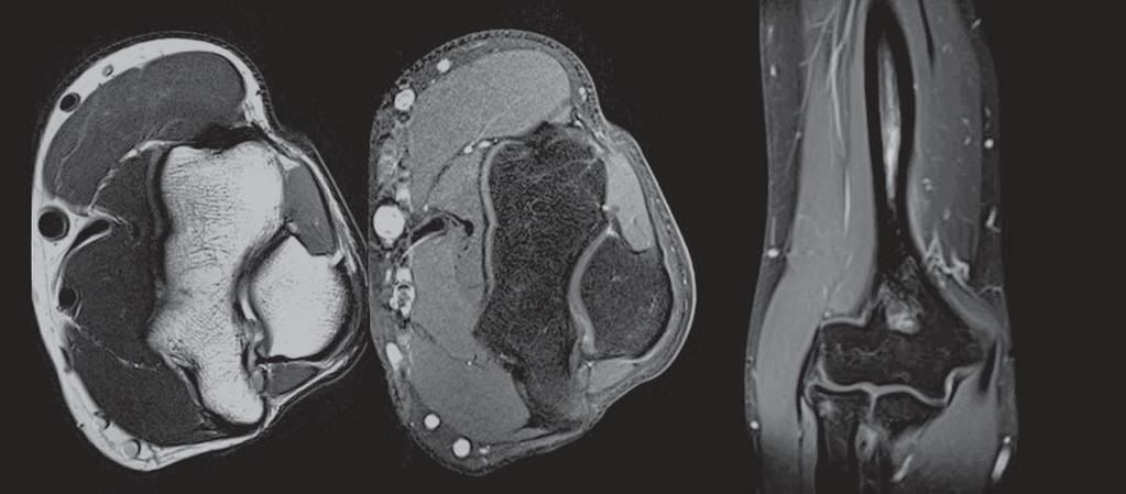 9 T2w TSE T1w TSE fat-sat after contrast injection 9 2 mm thin slices acquired off-center in this young patient with elbow pain demonstrate homogenous image quality.