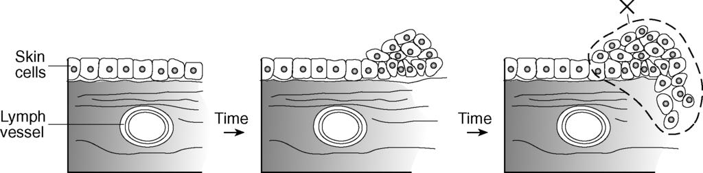 31. In a cell, protein synthesis is the primary function of. ribosomes. mitochondria. chloroplasts D. vacuoles 34. Melanoma is a type of cancer in which abnormal skin cells divide uncontrollably.