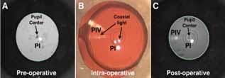 Using Purkinje Images to Improve IOL Centration Recreating the angle of the light source and patient's gaze intraoperatively are the keys to making this method reproducible. BY DANIEL H.