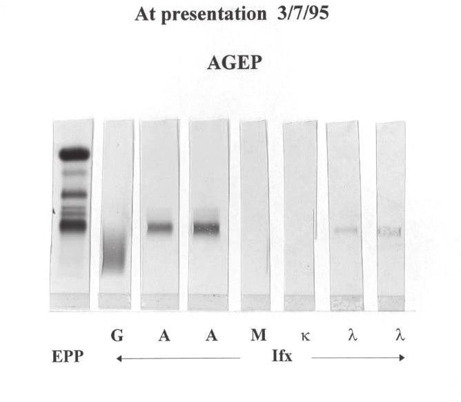 Abnormal Protein Bands Post-transplant in Myeloma 1A At presentation 3/7/95 AGEP 1B 11/7/97 AGEP MB 1C AGEP 1D IEF APB APB M-protein OB Figure 1.
