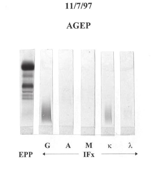Panel A shows at diagnosis the presence of an IgA lambda band (MB) in the beta region on agarose gel electrophoresis (AGEP) and immunofixation electrophoresis (); Panel B shows disappearance of the