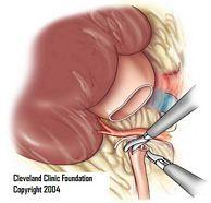 Relief surgery (pyeloplasty) pyeloplasty Ureteropelvic junction (UPJ) obstruction