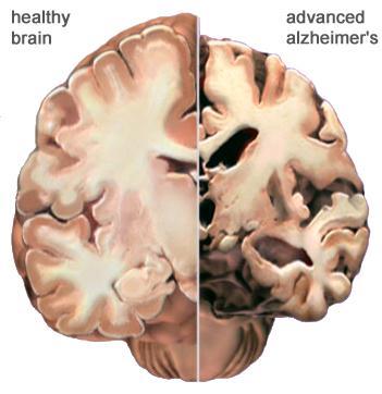 2.2.4 Alzheimer s In Alzheimer s disease, neurons and synapses are lost in the brain (see figure 3), causing patients to experience dementia and loss of other cognitive functions.