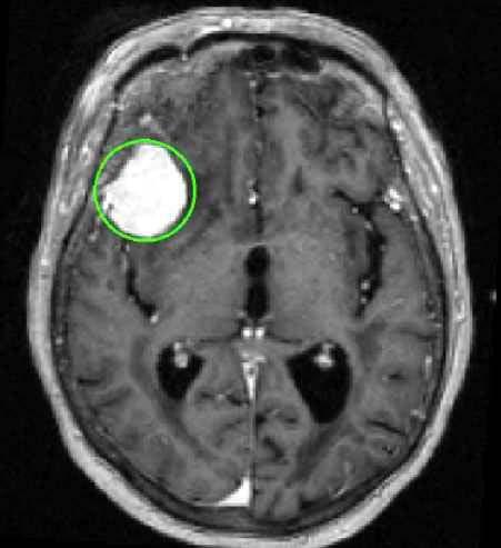 Research Context No debate about certain examples: A brain tumor discovered on a research MRI