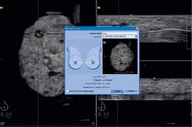 syngo.ultrasound Breast Analysis software can be installed as an independent application on a customer-provided computer or workstation.