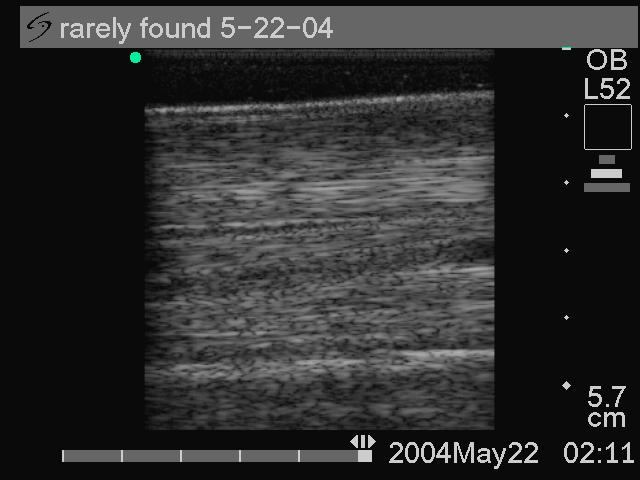 Ultrasound scan imaging showed a transition to a more uniform echogenicity with a complete reduction of the SDFT core lesion to a well defined tendon cell, fibrin and collagen filled area indicative