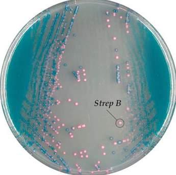 CHROMagar Products CHROMagar StrepB Code: 1109 Group B Streptococcus (GBS) has been associated with severe neonatal infections such as septicaemia and meningitis.