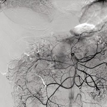 electrophysiology cases or transcatheter aortic valve implantations (TAVI).