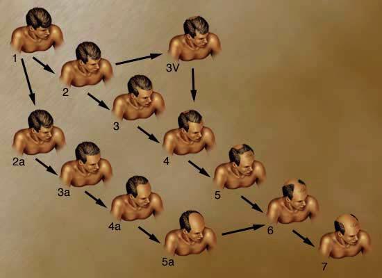 Male pattern baldness Sex influenced trait u autosomal