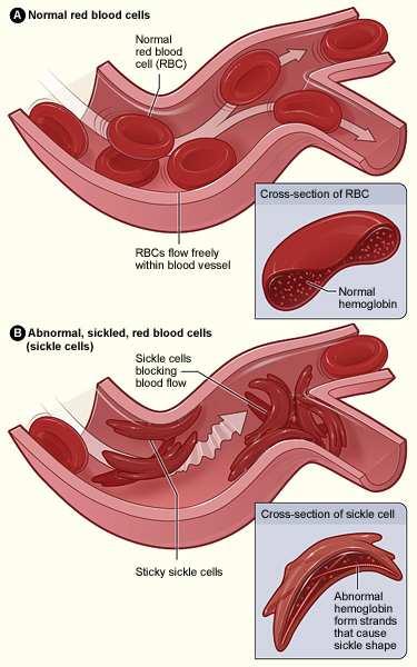 Sickle Cell Anemia This disease is incurable currently.