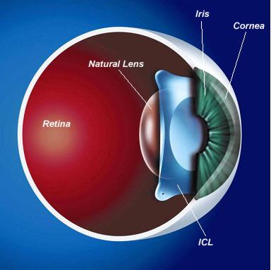 STAAR SURGICAL IS a Leading Developer, Manufacturer and Marketer of BUILDING Premium A Implantable FOUNDATION Lenses FOR CONSISTENT for Refractive GROWTH Vision Correction Implantable Collamer Lens