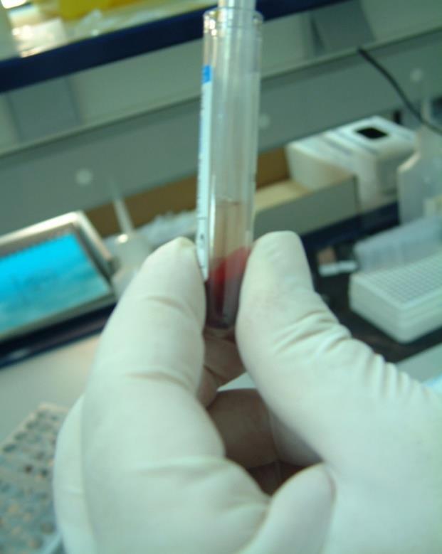Platelets Platelet count in PRP Peripheral blood, were centrifugated: A 500 g B 600 g for 10 min.