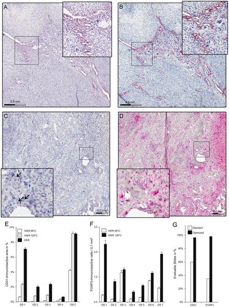 The type of retrieval matters (A) Formalin-fixed, paraffin-embedded osteosarcoma sample after CD31 staining with standard heat induced epitope retrieval at 98 C (B) with optimized enzymatic epitope