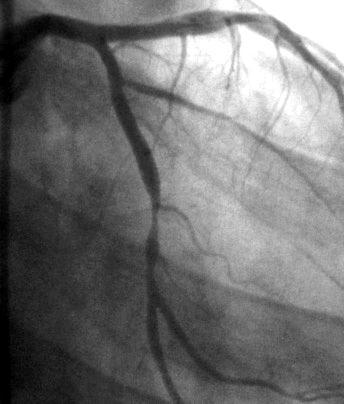 What is coronary artery disease (CAD)?