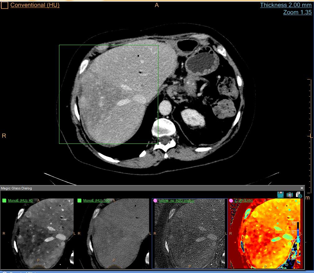 This industry-wide innovation effort that lasted from 2008 through 2013, often referred to in the industry jargon as the slice wars, has served to enhance CT s capabilities in whole-organ imaging