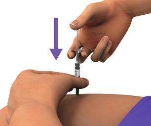 Figure J Step 9: Slowly push the plunger down until the syringe is empty (See Figure K). Figure K Step 10: Pull the needle out of the skin (See Figure L).