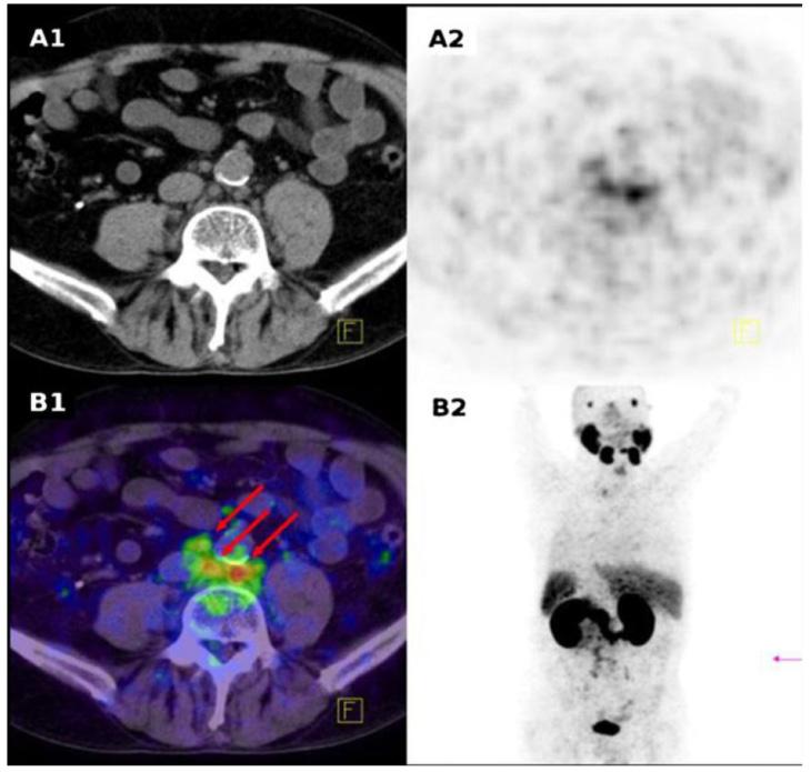 Fig 12. 68 Ga-PSMA PET/CT of patient 22 who received the lowest dose of radiotracer (52 MBq). Red arrows point to several small lymph nodes with clearly visible pathological tracer uptake.