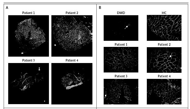 Immunocytochemisty of muscle biopsies from untreated patient (DMD), healthy control (HC) and the 4