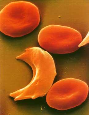 Sickle cell anemia Characterized by red blood cells that assume an abnormal, rigid, sickle shape Occurs because of a mutation in the hemoglobin gene,