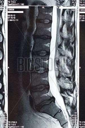 x-rays reveal punched-out lytic lesions,