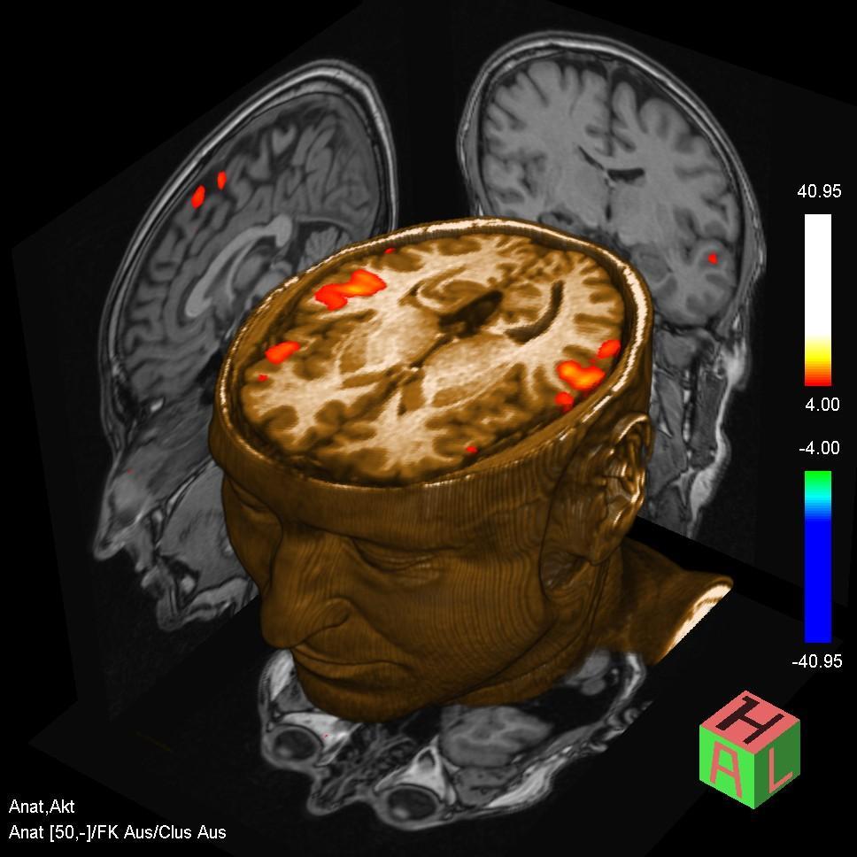 Benefits for fmri: more