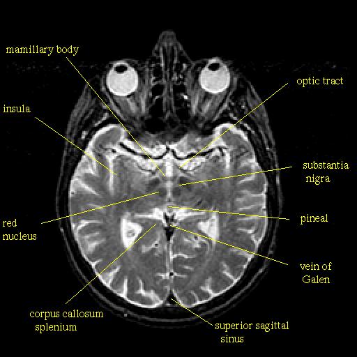 Human brain as seen by MRI: anatomy