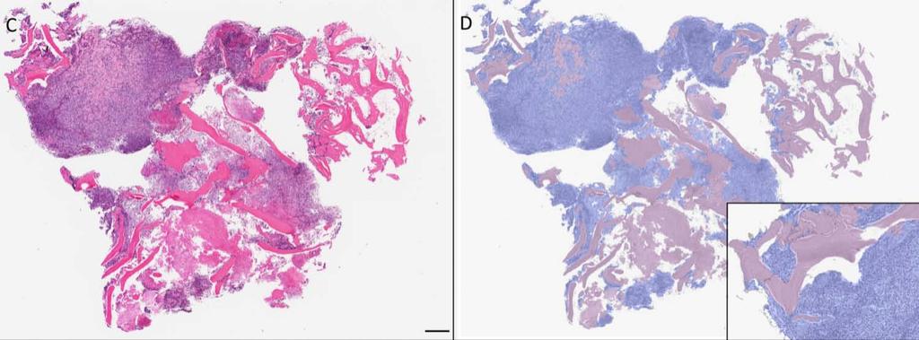 Quantification of Osteosarcoma in Tissue Biobank