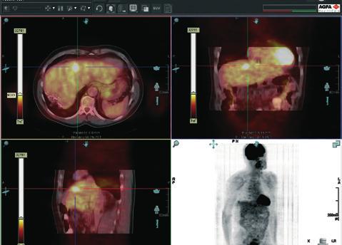 IMPAX Virtual Colonoscopy provides the radiologist with automated navigation tools or interactively manipulates the virtual camera to inspect the colon.