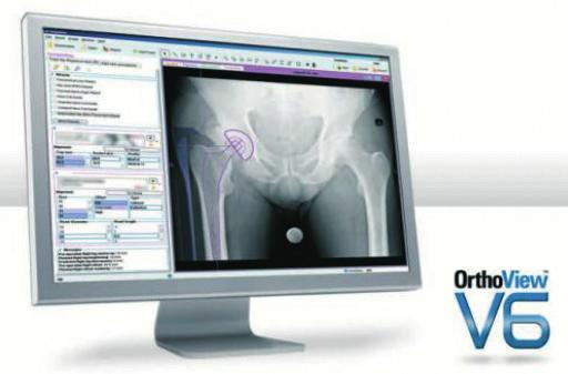 OrthoView for IMPAX IMPAX Orthopaedic Tools integrated set of preoperative surgical planning tools for the IMPAX workstation fulfills the evolving needs of filmless medical imaging facilities.