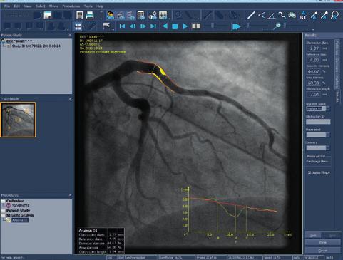 Qangio for IMPAX Qangio is the industry-leading software solution for the analysis of peripheral vessels in angiograms.