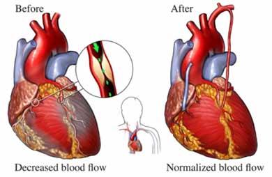 bypass procedure using a cardioplegic solution while a heart-lung machine takes over the blood circulation and breathing functions of the body.