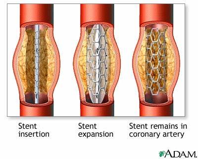 exposed to heat. Immediately following balloon angioplasty, the memory alloy stents are expanded with hot saline.