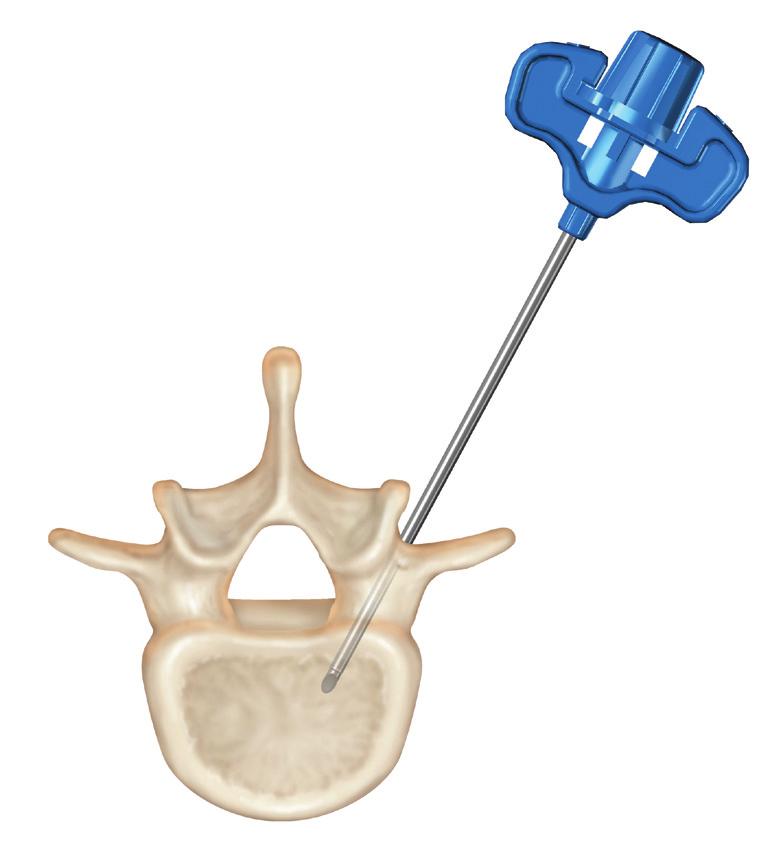 Surgical Technique BONE ACCESS NEEDLE PLACEMENT Under fluoroscopy, insert the bone access needle (working cannula and stylet) down to the appropriate entry location to the vertebral body.