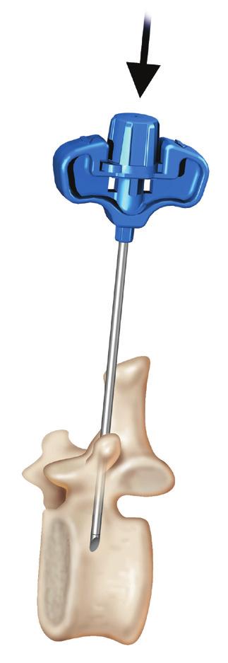 During needle advancement, great care should be taken to avoid breaching the medial border of the pedicle.