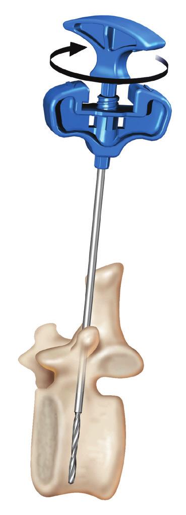 Surgical Technique BONE DRILL - SPACE CREATION If the predicted location of the mesh bag (indicated by the location of the drill tip) is unsatisfactory, re-position the working cannula and drill