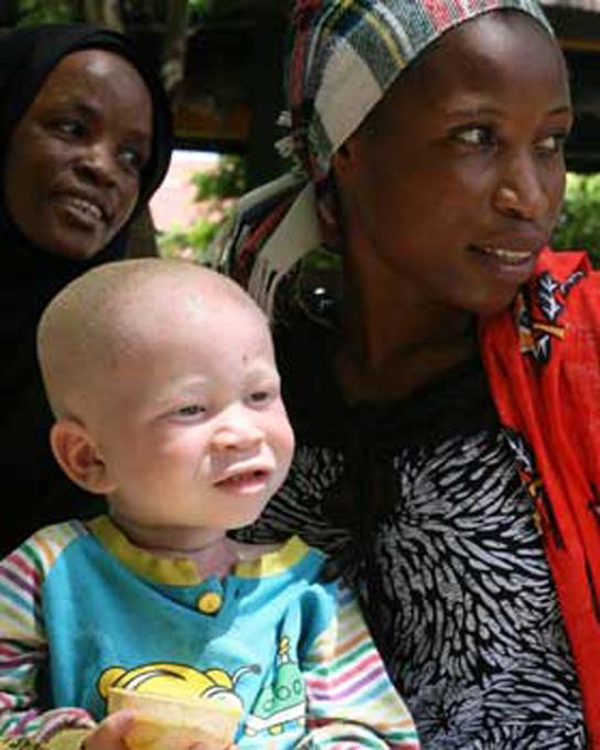 OpenStax-CNX module: m62819 4 Figure 1: The child in the photo expresses albinism, a recessive trait.
