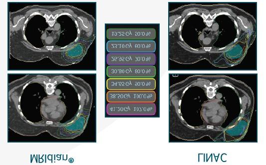 Clinical Studies: Instead of relying on existing bones or implanted fiducial markers, the MRIdian system s real-time imaging enables the physician to track the movement of the tumor and the