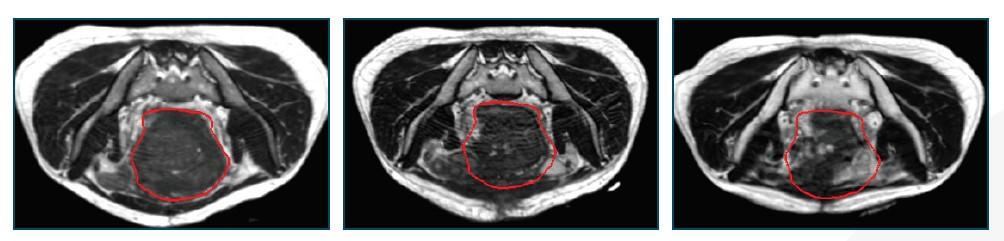 com) Adenocarcinoma of Distal Esophagus: The image above left shows the GTV delineated by the physician from the CT simulation.
