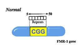 chromosome mutation of FMR1 gene causing many repeats of CGG triplet in promoter region 200+ copies normal = 6-40 CGG repeats FMR1 gene
