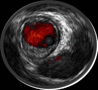 IVUS Guidance Is Associated with Better Outcomes Research suggests that IVUS guided peripheral interventions result in better outcomes than angio guided interventions (90 ± 2% vs. 72 ± 3% p<0.001).