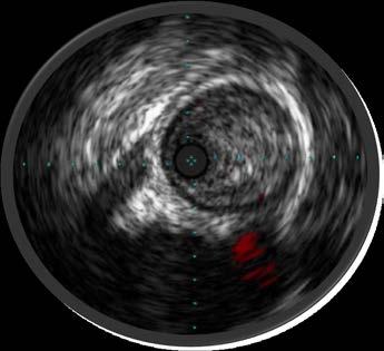 Ida O, et. al. Efficacy of Intravascular Ultrasound in Femoropopliteal Stenting for Peripheral Artery Disease With TASC II Class A to C Lesions. J Endovasc Ther. 2014 Aug;21(4):485-92. 2. Lee et al.