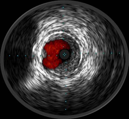 Confirming Your Results IVUS can aid you in assessing completeness of therapy.