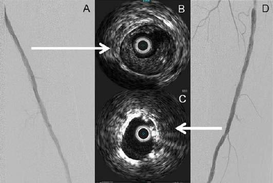 IVUS Provides You More Detailed Info Than Angio Alone IVUS aids your procedure by providing information: To assess plaque morphology To determine the