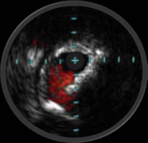 from IVUS-derived data. 1 Grading of calcification was moderate to severe in 40% by angiography but in only 7% by IVUS (p <.05).
