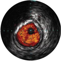 Assessing Therapy Completeness and Device Sizing IVUS can aid you in assessing completeness of therapy.