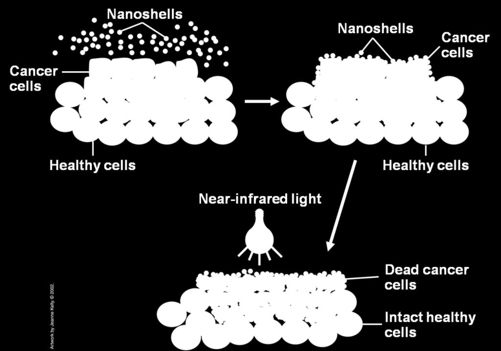 Termalno topljenje ćelija raka Nanoshells imaju metalni spoljašnji sloj oko zrna peska (SiO 2 ) Selektivno su privučeni ćelijama raka korišćenjem određenih molekula na površini ili usled fenomena
